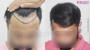 How To Get Natural And Fair Density From Hair Transplant?