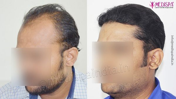 Hair Transplant - What Are The Options?