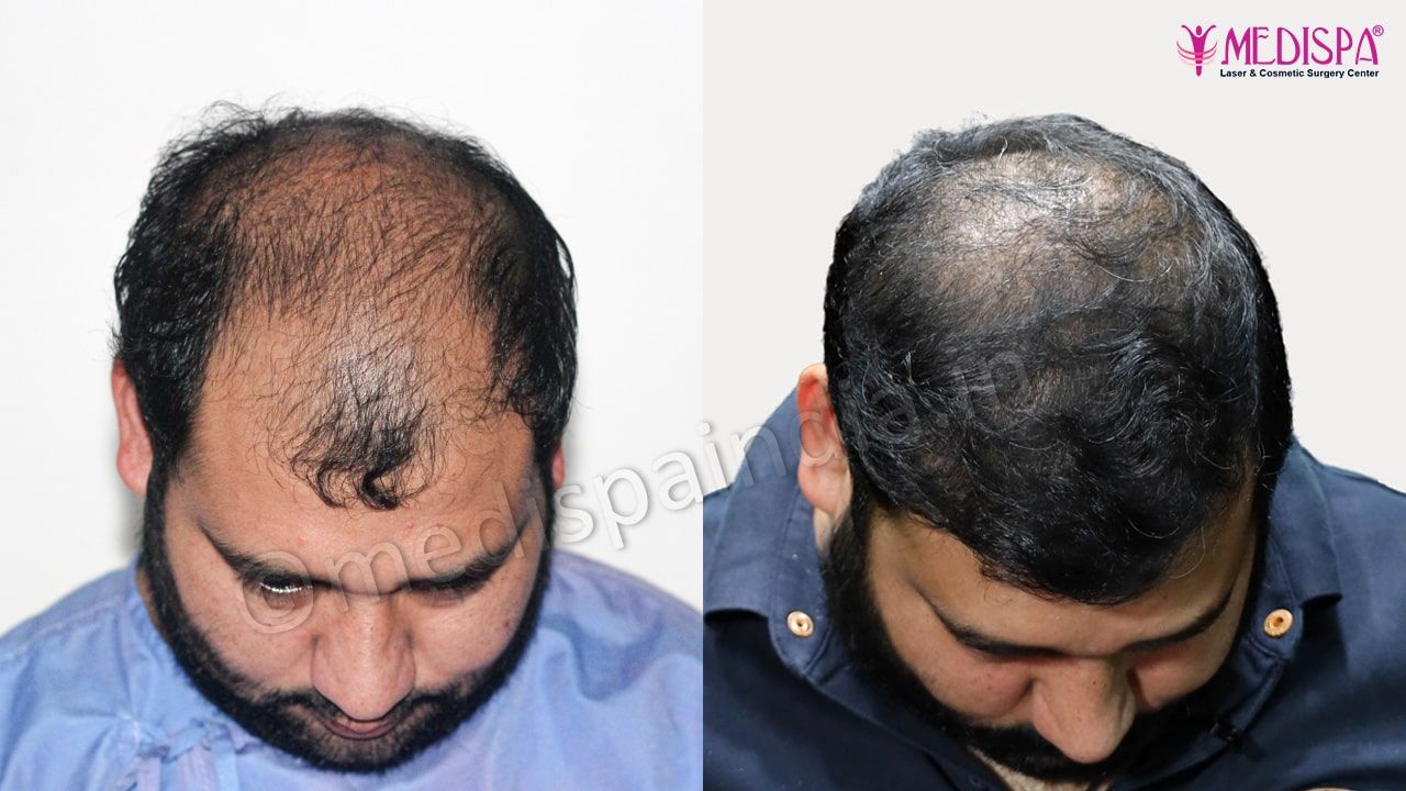 hair transplant