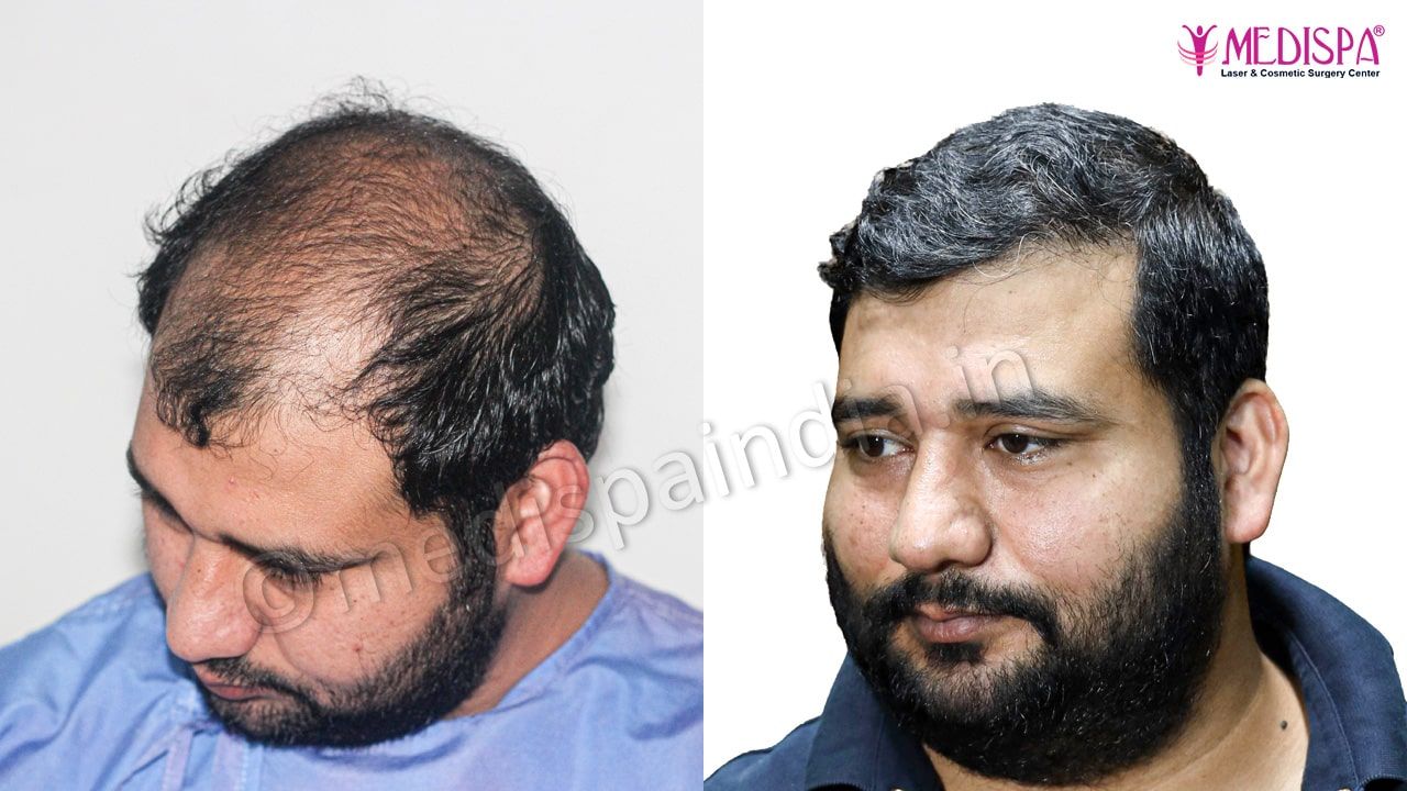 best hair restoration india results