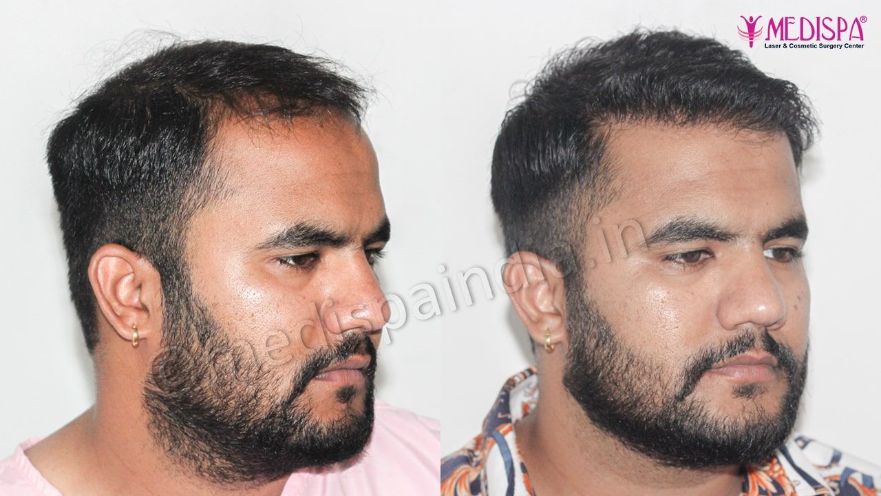 best hair restoration results in jaipur