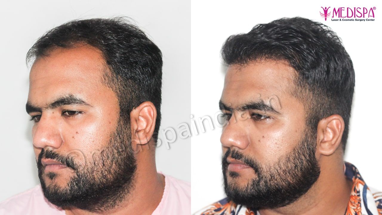 best hair restoration results in rajasthan