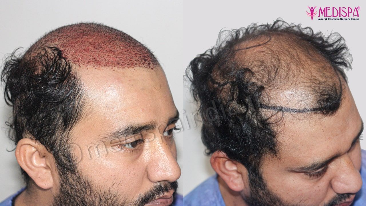 best hair transplant india result