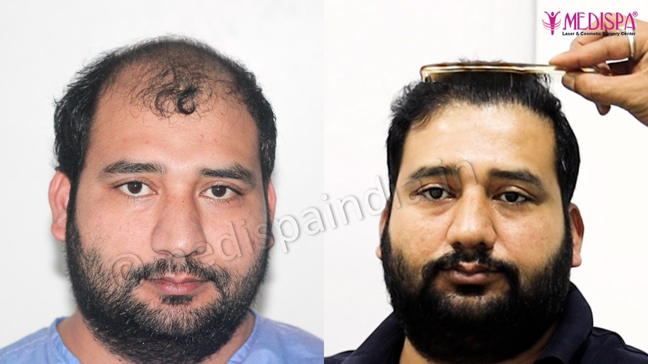 best hair transplant india results