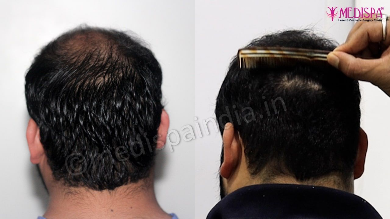 hair restoration india results