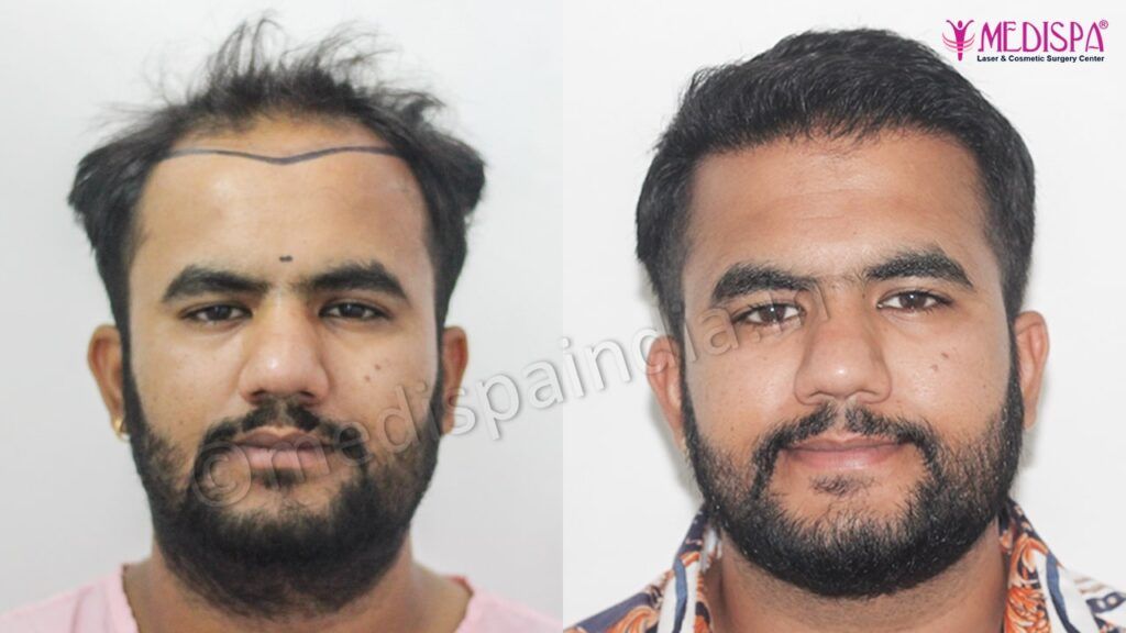 hair restoration results in rajasthan