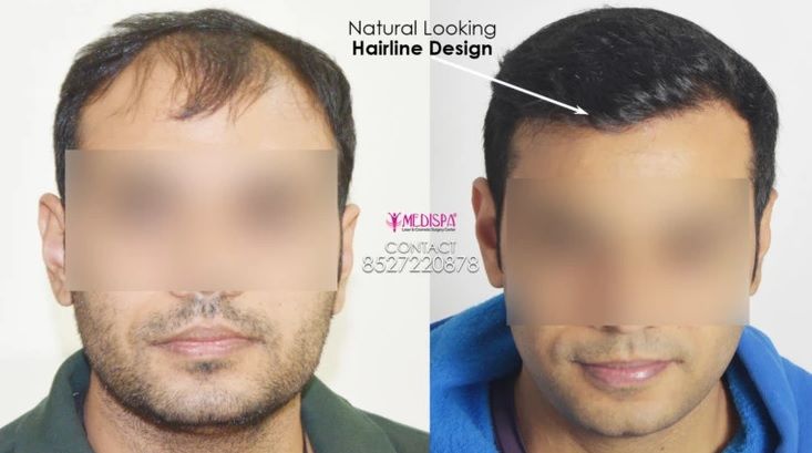 Importance Of Trichophytic Closure In Fut Hair Transplant 