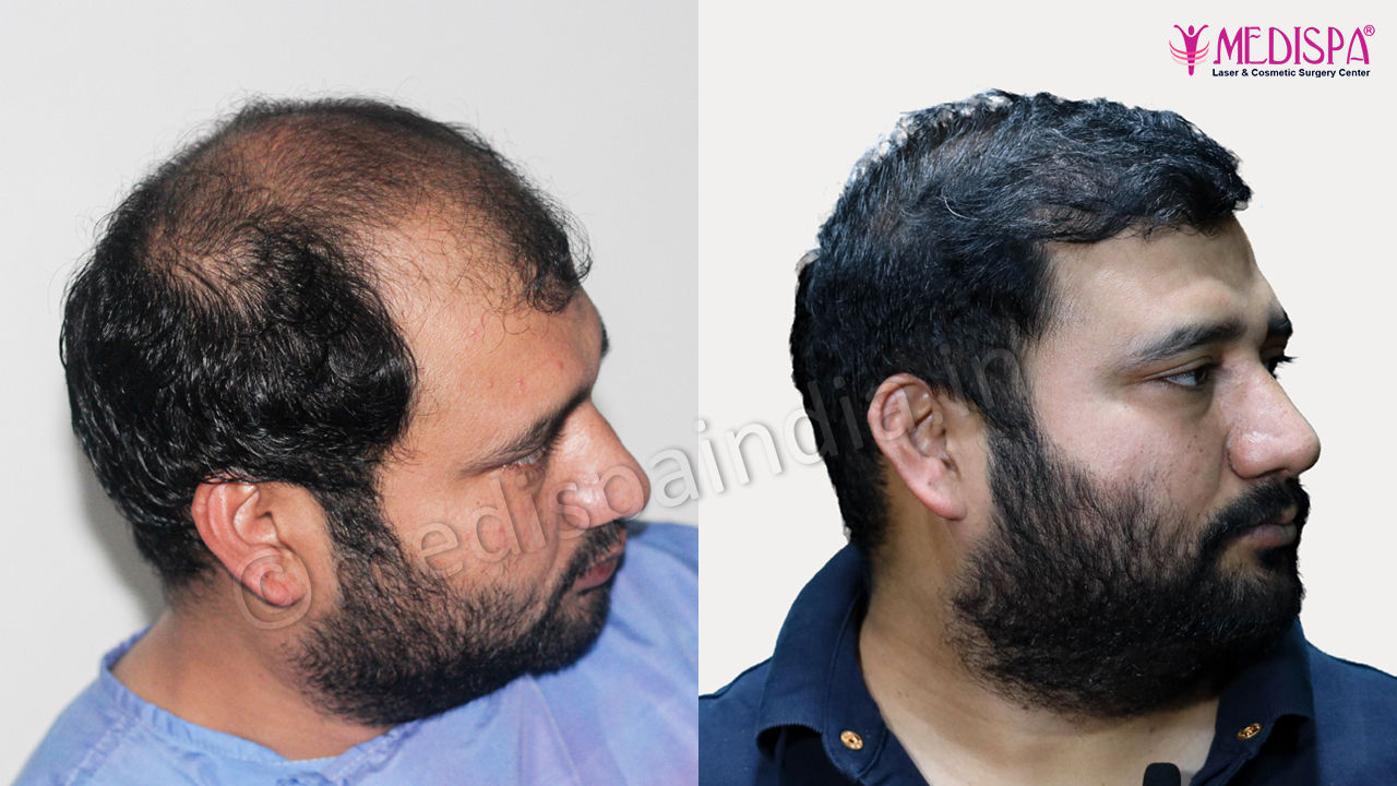 top hair restoration india result in rajasthan