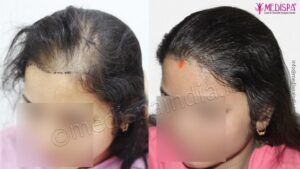 Hair Loss in Women: How Hair Restoration Can Help?