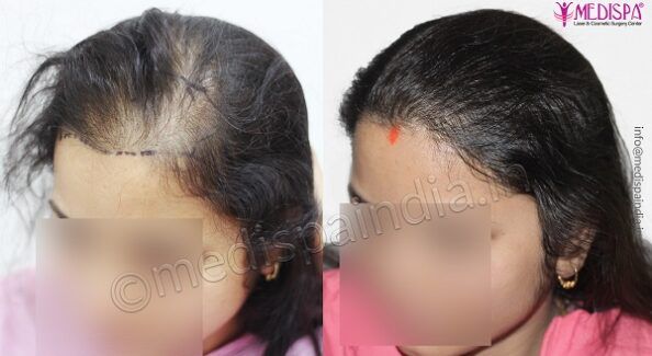 Hair Loss in Women: How Hair Restoration Can Help?