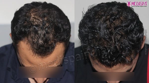 How To Get Rid of Pattern Baldness By Hair Transplantation?