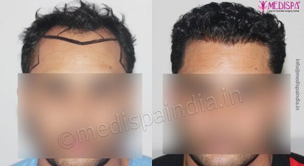 How To Determine Per Graft Cost For Hair Transplantation?