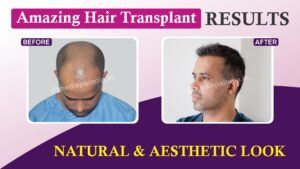 Why Hair Transplant Repair Can Be A Good Idea After A Bad Hair Transplant?