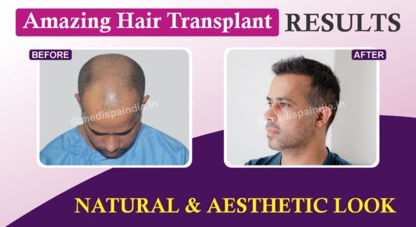 Why Hair Transplant Repair Can Be A Good Idea After A Bad Hair Transplant