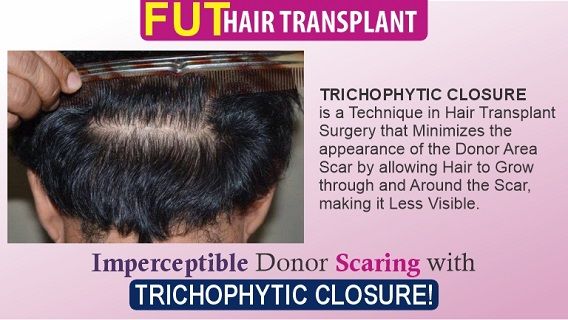 Explain The Significance of Trichophytic Closure in Hair Transplantation