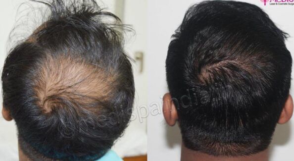 How To Get Successful Hair Transplant Results With Maximum Density?