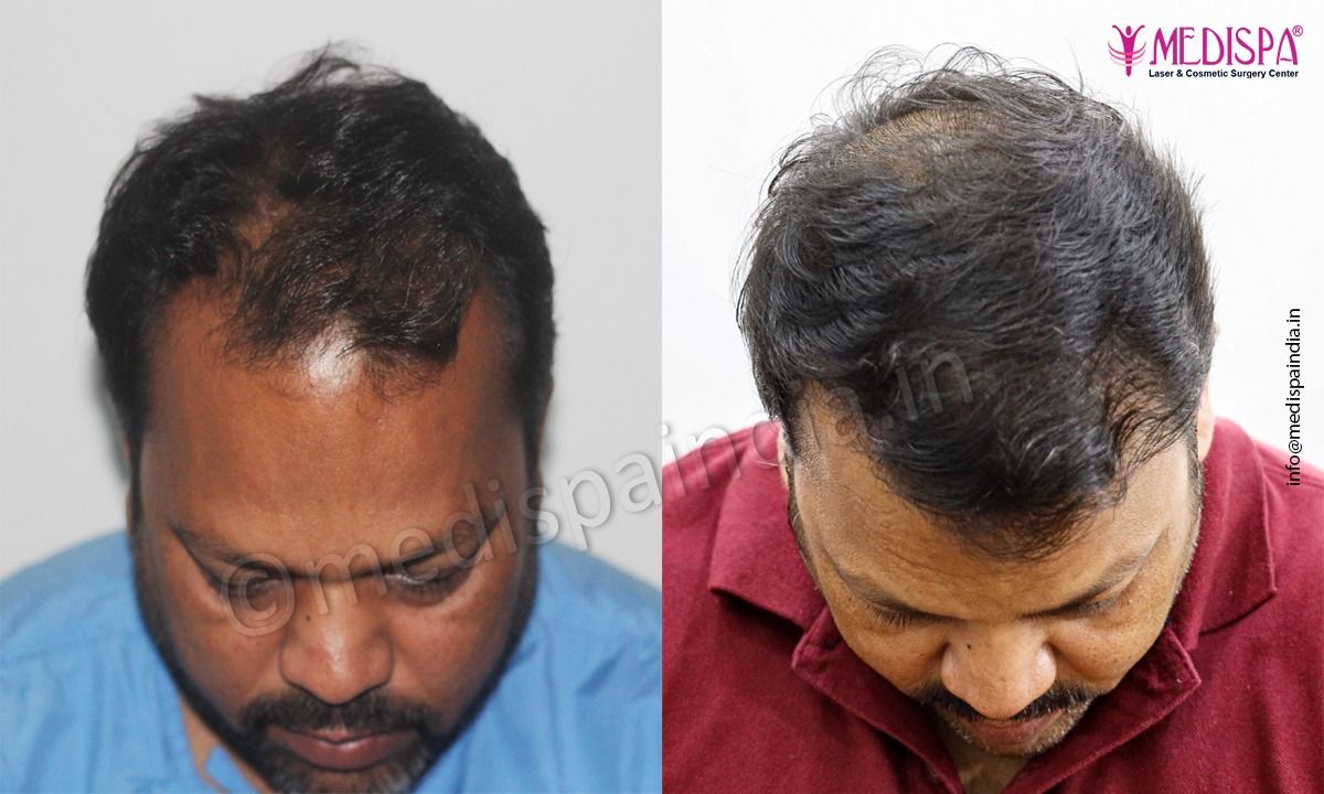 hair transplant price in delhi