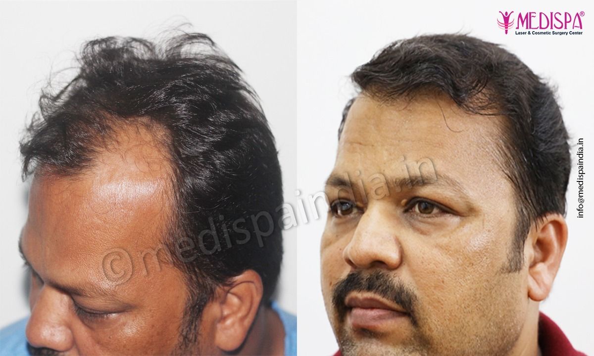 hair transplant price in gurgaon