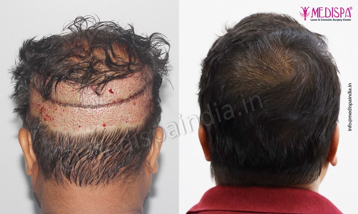 hair transplant price in india