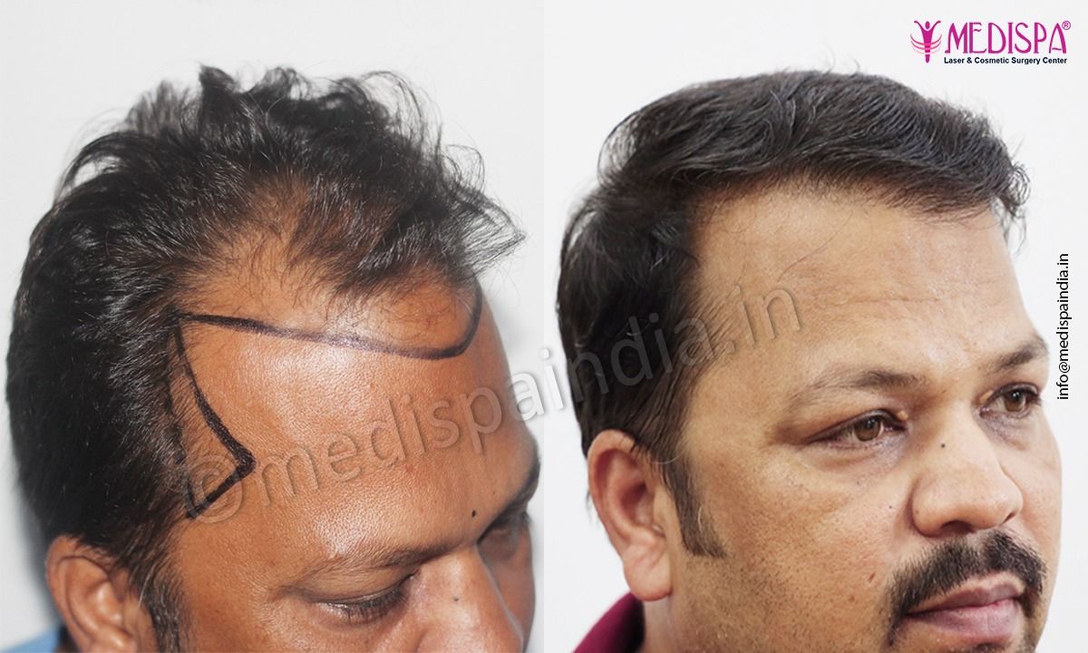hair transplant price in jaipur