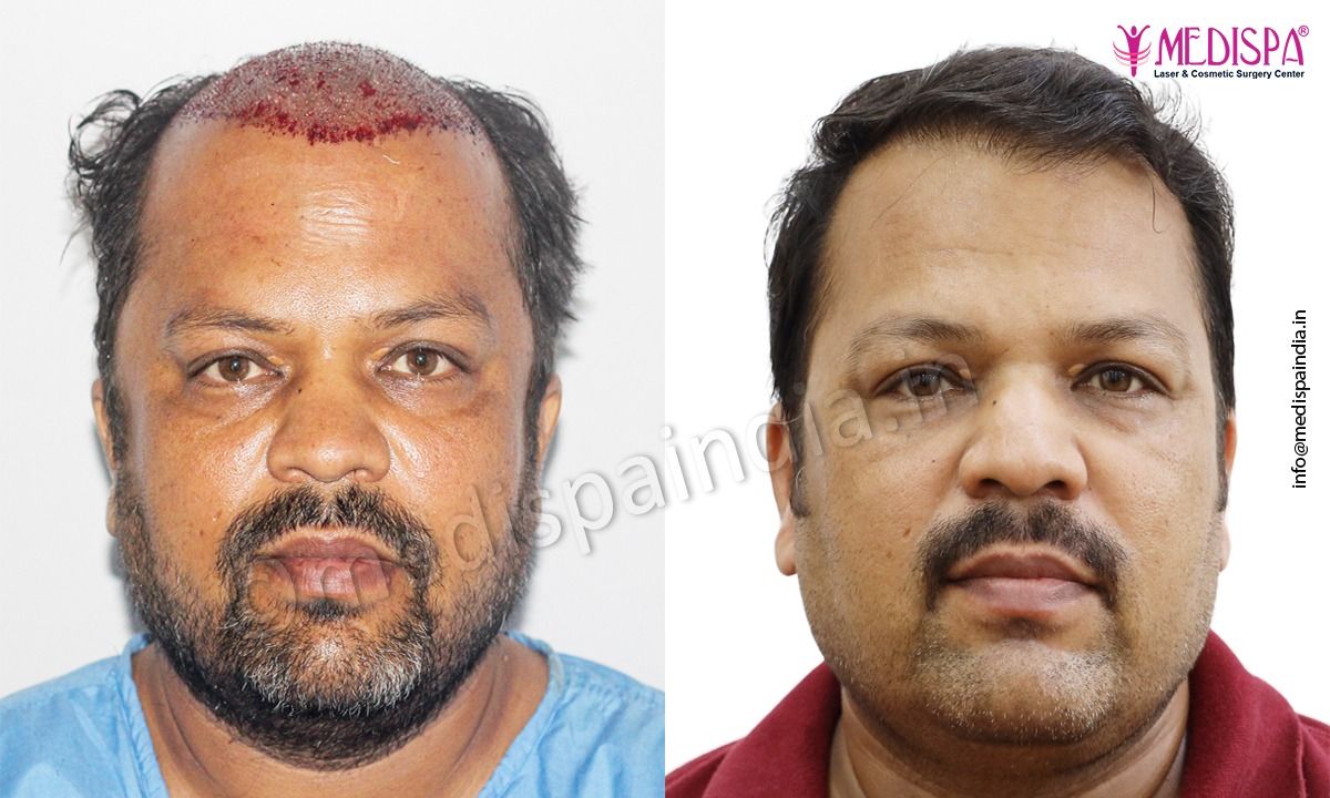 hair transplant price in rajasthan