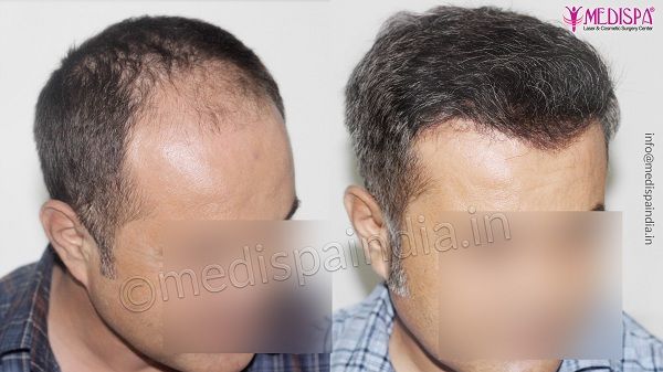 Explain The Things To Avoid After Hair Transplant Surgery