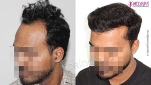 How To Take Care of Your Scalp After Hair Transplant Procedure?