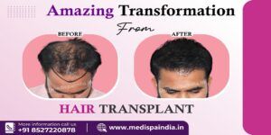 Explain The Importance of Graft in Hair Transplantation