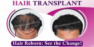 Medical Tourism For Hair Transplantation in India