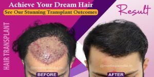 How Much Time It Takes To Get Visible Results After Hair Transplant?