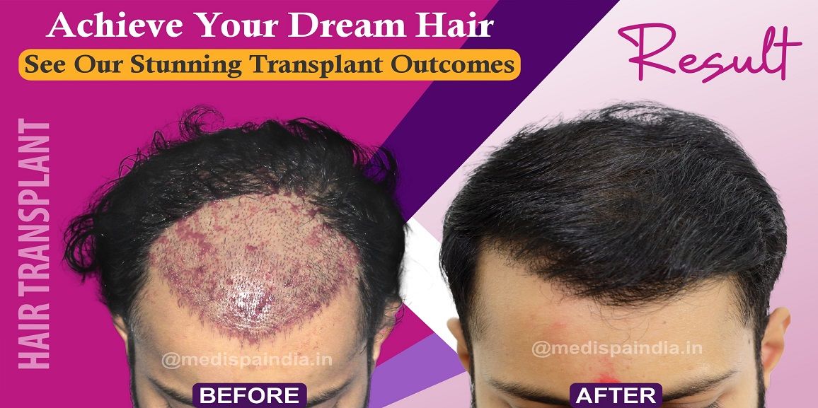 How Much Time It Takes To Get Visible Results After Hair Transplant?