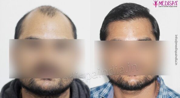 Is Choosing Hair Transplant Can Be Considered As The Right Choice?