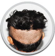 best hair restoration in jaipur