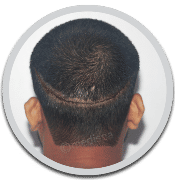 fut hair transplant jaipur