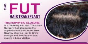 When Should You Opt For FUT Hair Transplant Technique?