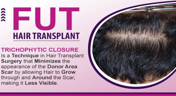 When Should You Opt For FUT Hair Transplant Technique?