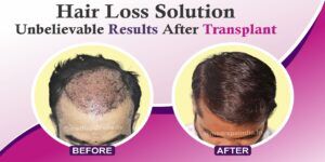 Hair Transplantation: Is It Really Effective To Cure Hair Loss?