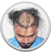 Jaipur hair restoration