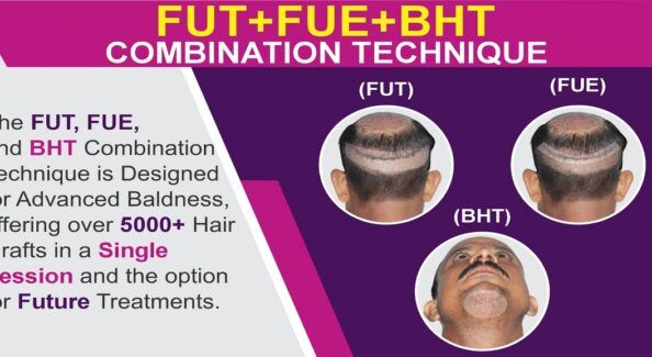 Facts You Must Know About FUT+FUE+BHT Combination Method