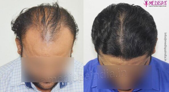 Why Is Hair Transplant Better Than Other Hair Loss Treatments?