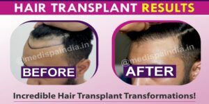 Why To Choose The Experienced Doctor For Hair Transplantation?