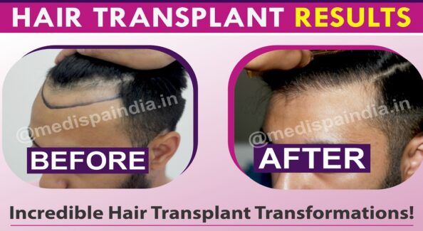 Why To Choose The Experienced Doctor For Hair Transplantation?