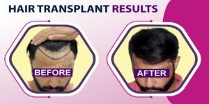 What Are The Types of Hair Transplant Offered in India?