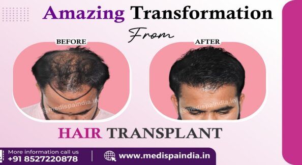 Is It Possible To Get Permanent Solution For Hair Loss By Hair Transplant?