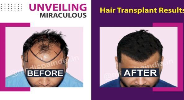 How To Get Safe And Effective Hair Transplant Surgery?