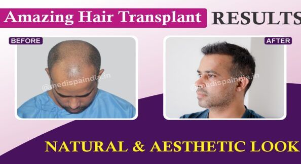 How Can Hair Transplant Help in Achieving Natural Hairline?