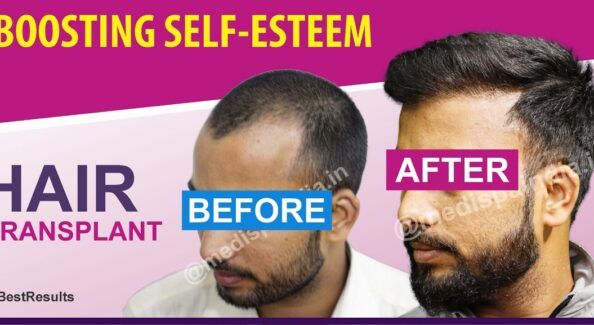 Are There Any Risks Involved With Hair Transplant Surgery?