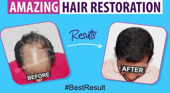 Who is The Ideal Candidate For Hair Transplant Surgery?