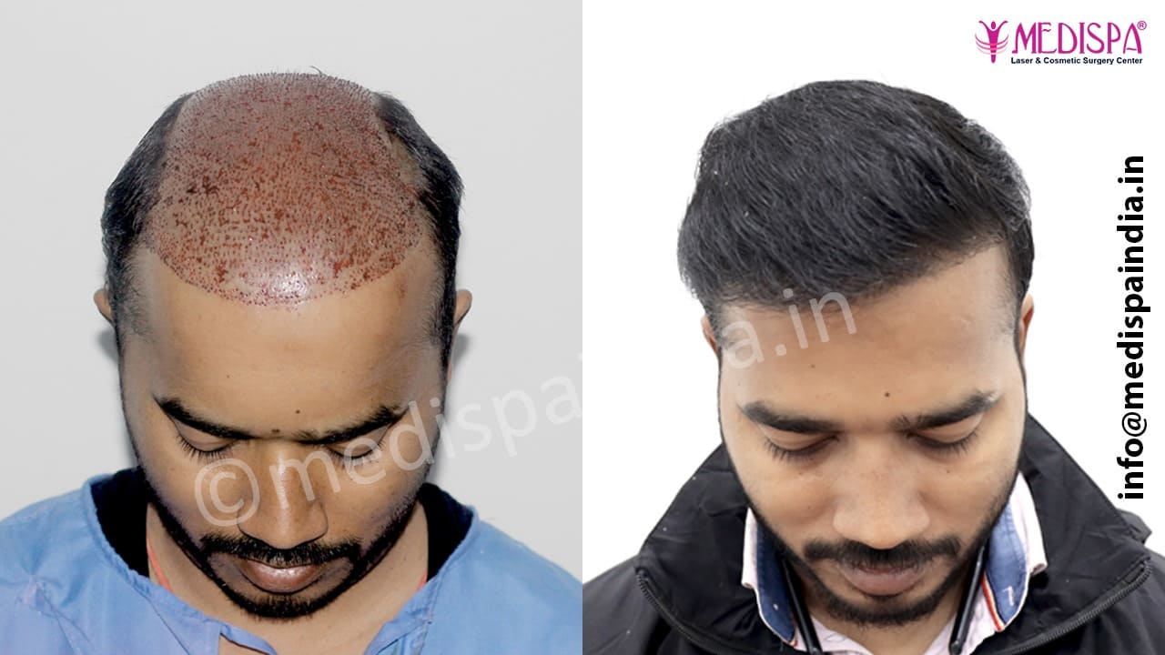 bad hair transplant repair in delhi