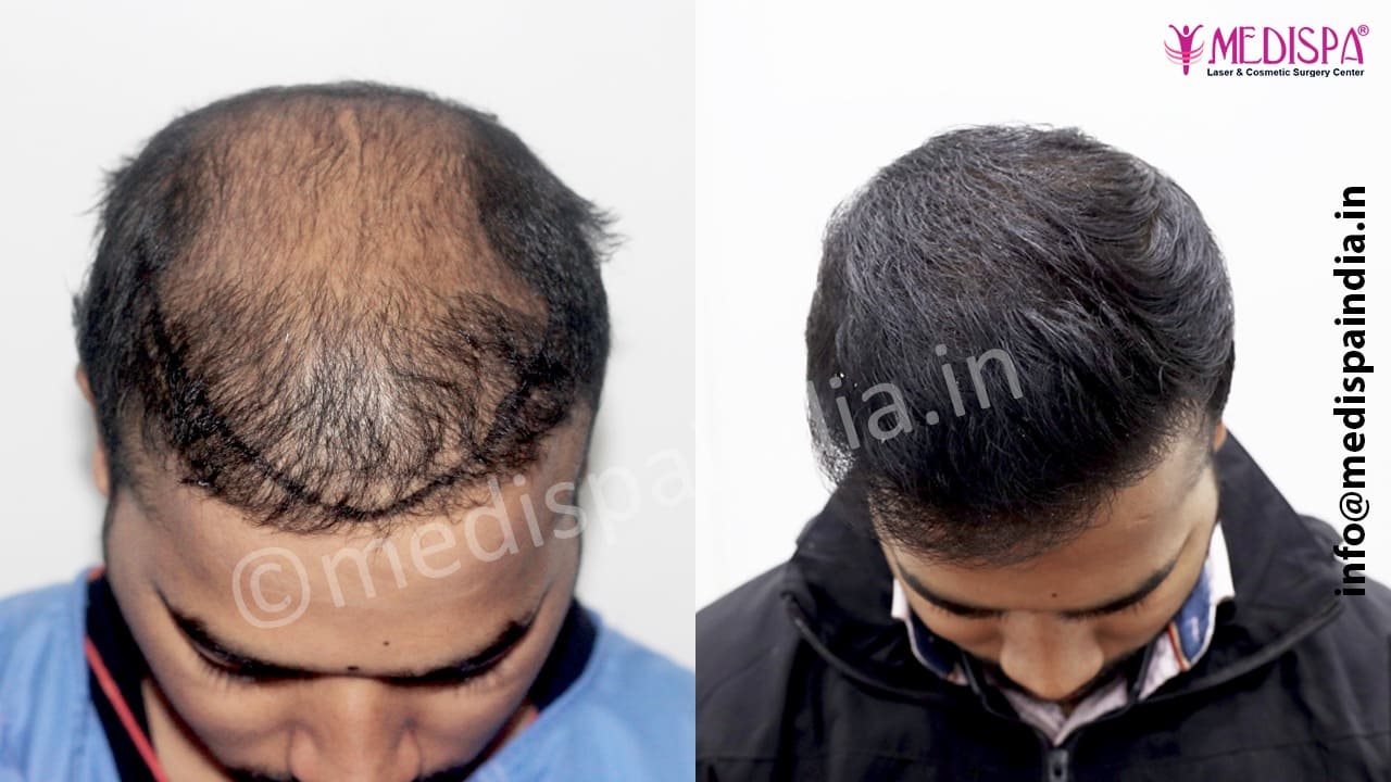 bad hair transplant repair in jaipur